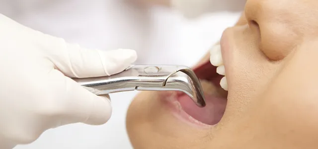 歯科口腔外科・欠損補綴